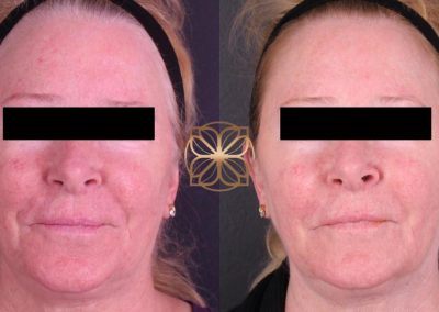 3 BBL, Halo, Gold Tip Facial, PRP and Filler to Marionettes Spa26 Beverly Hills