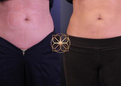 Before and after comparison of abdominal Kybella treatment, showing reduced fat and a more toned stomach area