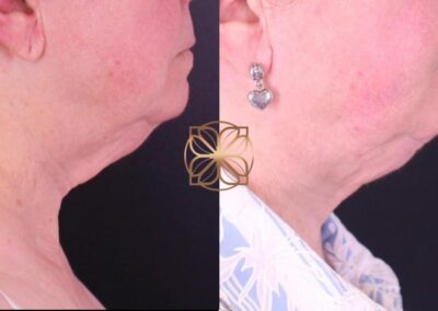 Profile view demonstrating early results of AccuTite neck lift treatment, with enhanced skin texture and neck line definition