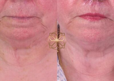 Early results of AccuTite treatment on lower face and neck after 2 weeks, seen in a patient from Beverly Hills