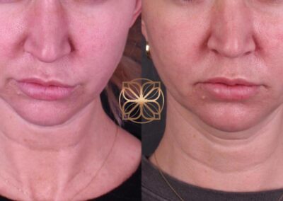Close-up view of AccuTite facial treatment results at 3 months highlighting tightened skin and improved lower face contours