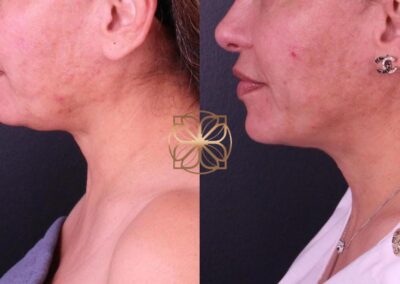 Side profile view before and after AccuTite lower face lift treatment, highlighting tightened skin and reduced necklines