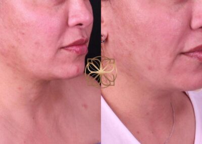 Detailed close-up of the improved lower face and jawline contour following AccuTite treatment, with a focus on skin texture and firmness