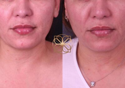 Before and after comparison of AccuTite lower face treatment in Beverly Hills, showing refined jawline and facial structure