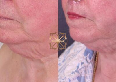 Close-up of neck rejuvenation 2 weeks following AccuTite treatment, showing skin tightening and contour improvement