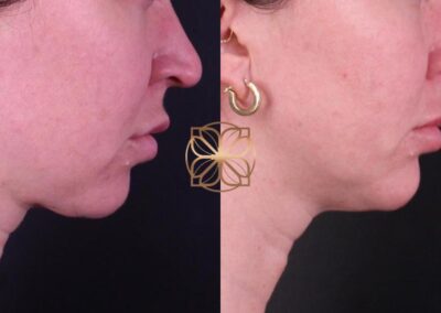 Side-profile after 3 months of AccuTite treatment, illustrating the improved definition in the jawline and neck area