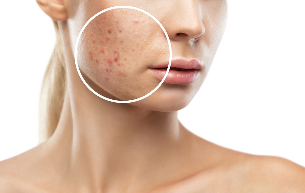 Close-up of a woman's face showing red, inflamed skin as a cause of acne rosacea