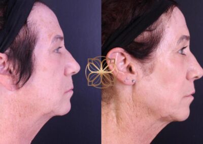 Progress of advanced facial treatment showing side profile before and after Erbium, FaceTite, lip lift, and earlobe reduction at a Beverly Hills clinic