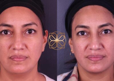 Facial aesthetic improvement with FaceTite and nose fillers, showing subtle refinement and sculpting