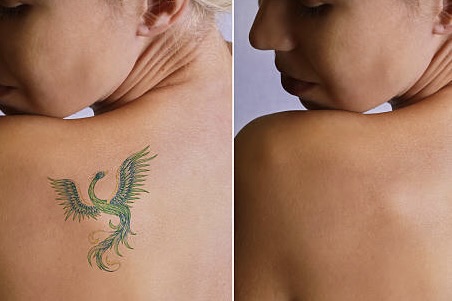 tattoo removal aftercare and recovery