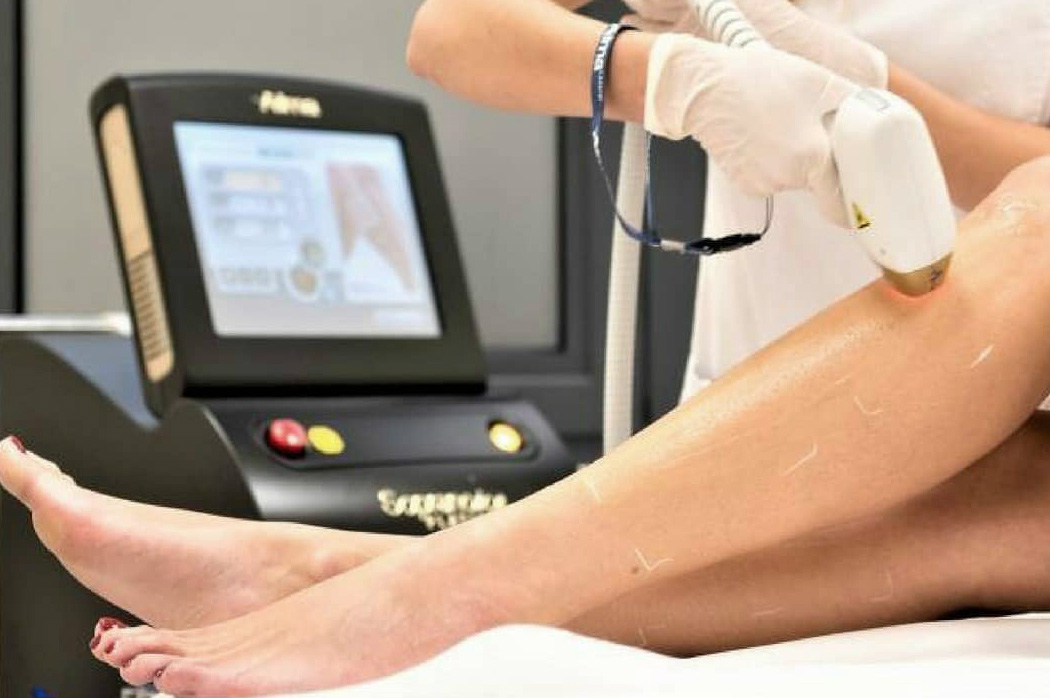 Alma Soprano ICE Platinum laser treatment for effective and painless hair removal on legs