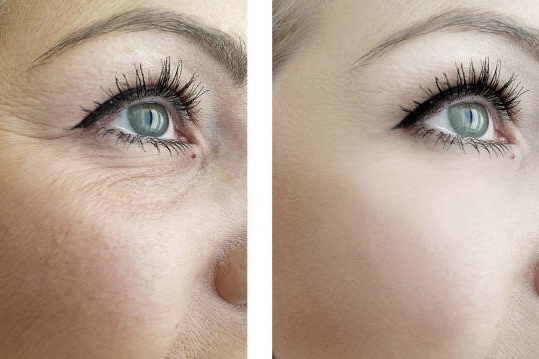 Am I a Good Candidate for HALO Fractionated Resurfacing