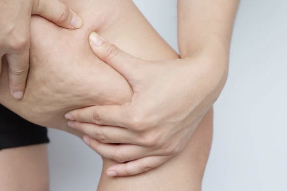 Am I a Good Candidate for Cellfina Cellulite Reduction