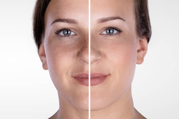 Am I a Good Candidate for Diamond Glow Microdermabrasion
