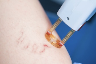 am i a good candidate for laser vein removal