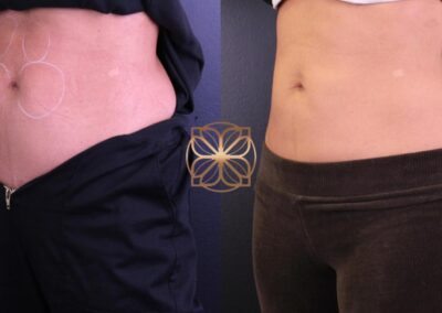 Angled frontal before and after view of abdomen Kybella fat reduction treatment, showcasing a slimmer waistline