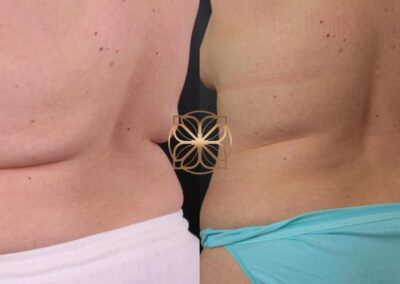 Back CoolSculpting 6 months postoperative results at a Beverly Hills clinic, exhibiting a more contoured and toned back area