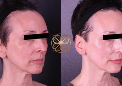 BBL and Halo After 1 Treatment Spa26 Beverly Hills