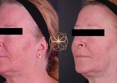 BBL, Halo, Gold Tip Facial, PRP, Filler to Marionettes Spa26 Beverly Hills