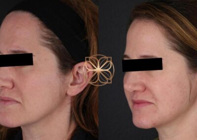 Profile view of Botox facial treatment effects, illustrating improvement in skin smoothness and wrinkle diminishment