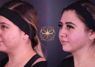 Before and after results of FaceTite and BFPR treatments at a Beverly Hills clinic showing skin improvement