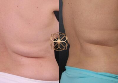Six-month post-op Back CoolSculpting treatment results in Beverly Hills, showcasing smoother and refined back contours