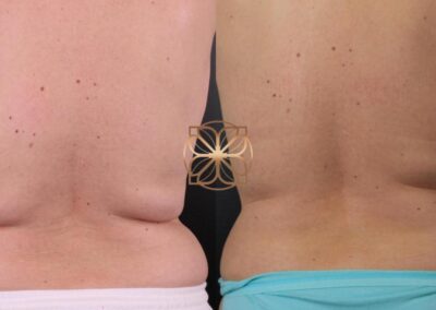 Refined back contouring from Back CoolSculpting treatment visible at 6 months post-op in Beverly Hills