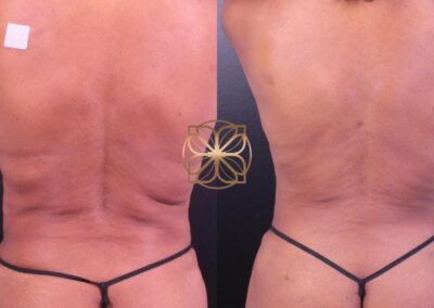 Results at 3 months after BodyTite Abdomen treatment with Mini-Tummy Tuck and Liposuction in Beverly Hills, showcasing enhanced abdominal definition