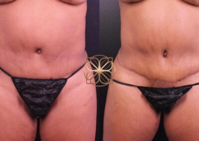 bodytite abdomen mini-tummy tuck liposuction results beverly hills