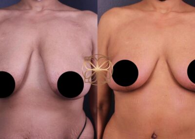 Three months after extensive BodyTite procedures including abdominoplasty, liposuction, and breast lift with fat transfer in Beverly Hills, showing a refined body silhouette