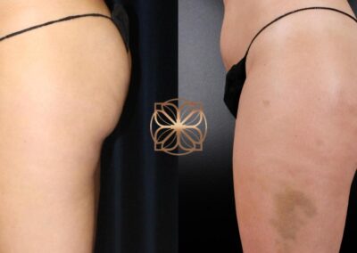 Nine-month post-operative results of Cellfina Cellulite Reduction treatment at a Beverly Hills clinic, demonstrating a smooth and improved skin texture