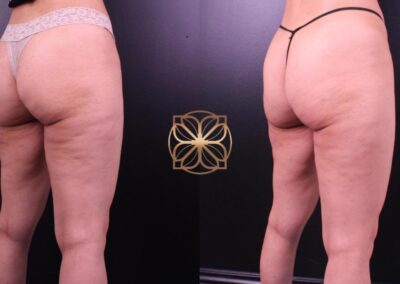 Post-Cellfina Cellulite Reduction treatment results in Beverly Hills, showcasing smoother and toned buttocks and thighs