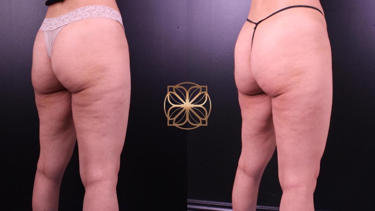 Post-Cellfina Cellulite Reduction treatment results in Beverly Hills, showcasing smoother and toned buttocks and thighs