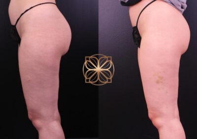 Before and after comparison of Cellfina Cellulite Reduction treatment on the thigh at a Beverly Hills clinic, showing smoother skin and less visible cellulite