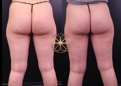 Before and after cellulite treatment revealing smoother skin and reduced dimpling on the thighs and buttocks in Beverly Hills