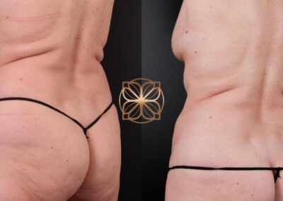 Transformation evident at 2 months following CoolSculpting treatment, with reduced fat and smoother body contours