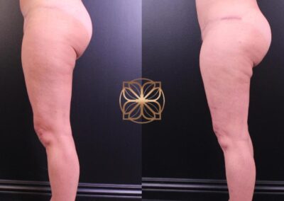 4.5 months post-operative results from combined BodyTite, breast surgery revisions, and mini tummy tuck, showing a sculpted and enhanced body silhouette