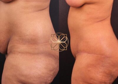 Three months after an extended abdominoplasty, BodyTite, and liposuction on thighs and arms, coupled with a breast lift and fat transfer, showing significant body contour enhancements