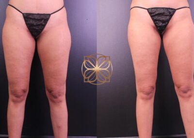 Before and after comparison of BodyTite knee sculpting treatment, showing improved leg contour and smoother skin texture