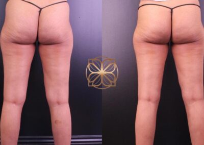 Before and after results of BodyTite treatment on knees, demonstrating tightened and smoothed skin in Beverly Hills clinic