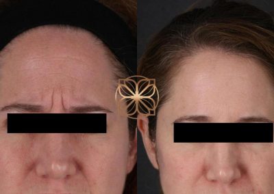 Botox 3 Weeks Post Op Spa26 Beverly Hills