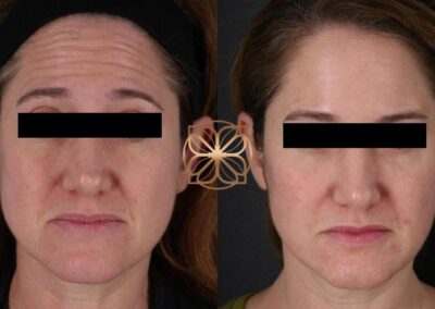 Frontal view comparison of Botox facial rejuvenation displaying reduction of facial lines and wrinkles
