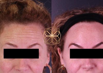 Botox Spa26 Beverly Hills