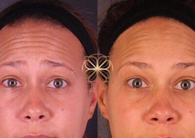 Before and after Botox treatment with a surprised expression, demonstrating softened forehead lines with preserved facial dynamics