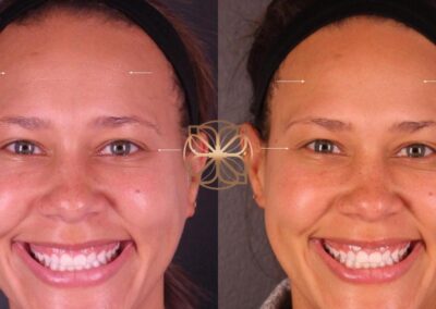 Before and after Botox treatment on a smiling woman, with softened facial lines yet preserved natural expression