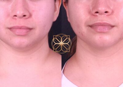 Post-treatment results of Buccal Fat Removal and FaceTite in Beverly Hills, showcasing a slimmer facial profile and enhanced contours