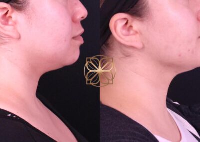 Side profile comparison before and after Buccal Fat Removal and FaceTite treatment, highlighting the sculpted jawline and neck