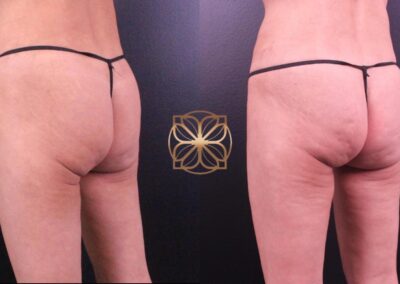 Before and after comparison of buttocks enhancement with filler following two treatment sessions