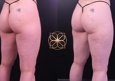 Cellfina and Liposuction Outer Thighs 3 Months Post Op Spa26 Beverly Hills