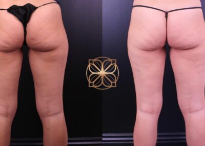 Cellfina Cellulite Reduction treatment results 5 months post-op in Beverly Hills, showing significant smoothing of the skin on the buttocks and thighs